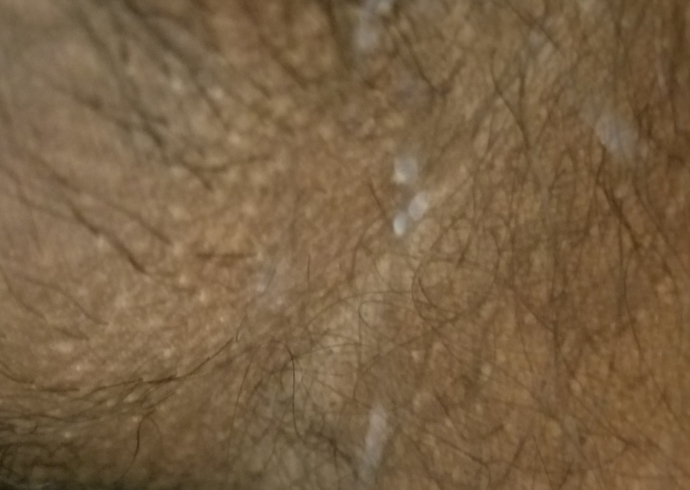 Follicle Bumps