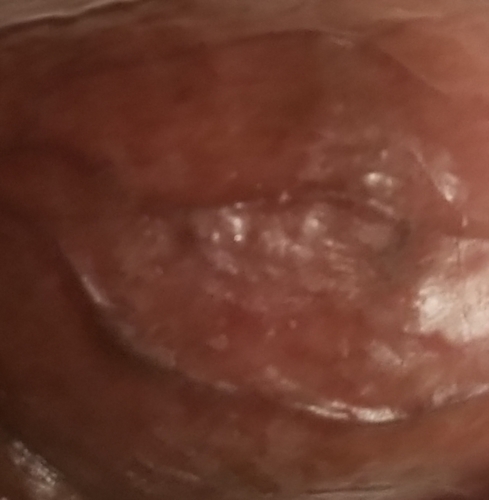 penis Under foreskin