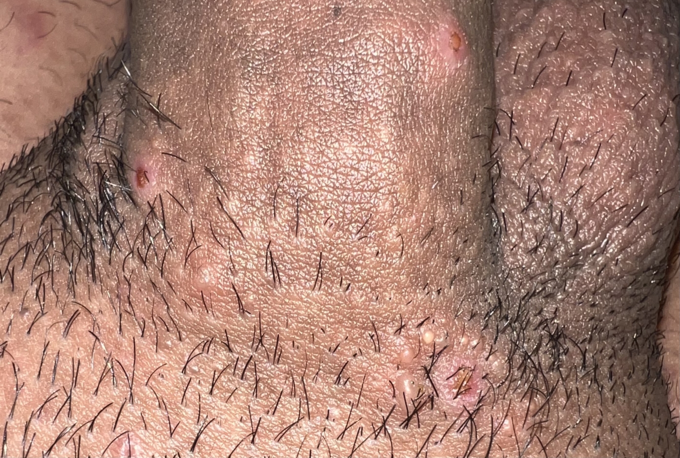 Little Bumps on Genitals: Understanding These Common Concerns